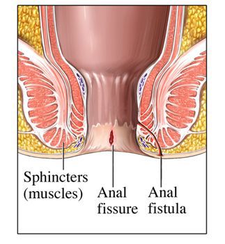 fistel anus