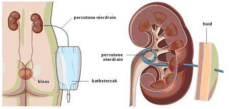 nefrostomiekatheter