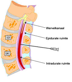 spinale pijnbestrijding