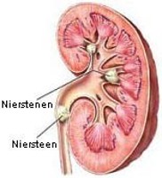 afbeelding van een nier met een niersteen