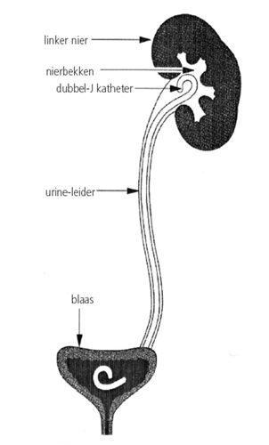 dubbel-J katheter