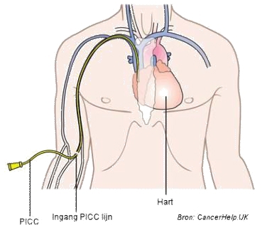 picc-lijn